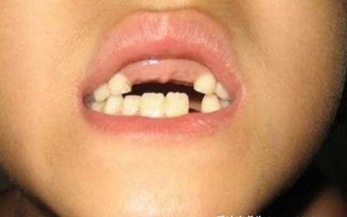 做梦梦到牙齿掉了是什么意思(孕妇做梦梦到牙齿掉了是什么意思)